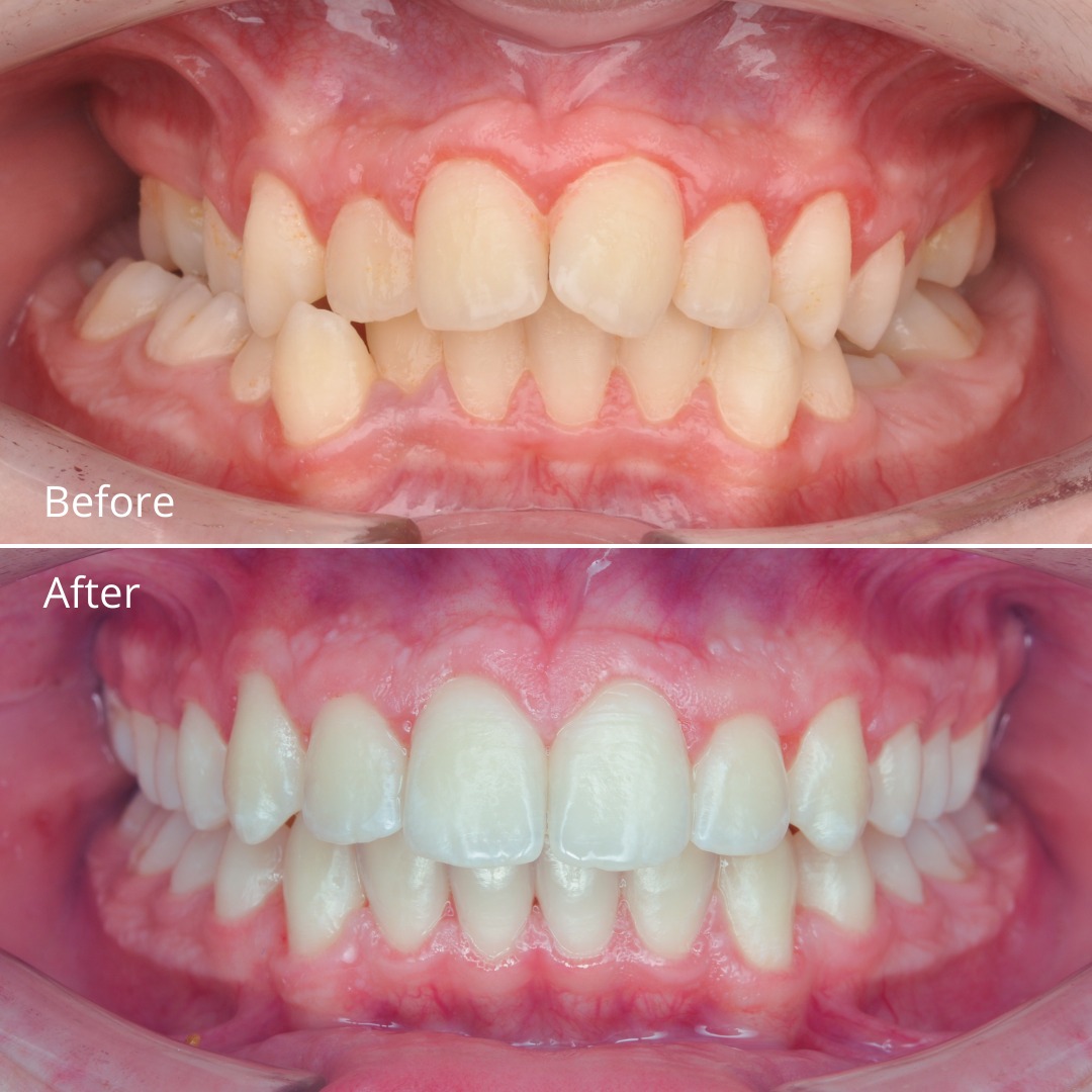 Stage of treatment showing early correction of the crossbite and arch width — photo 2 of 6