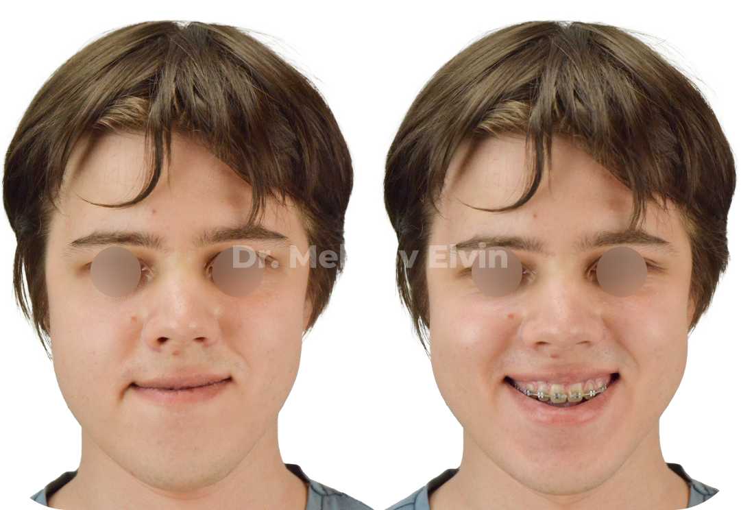 До ортогнатической операции.