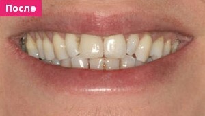 На картинке изображена улыбка после протезирования зубов в стоматологическом медицинском центре Оазис