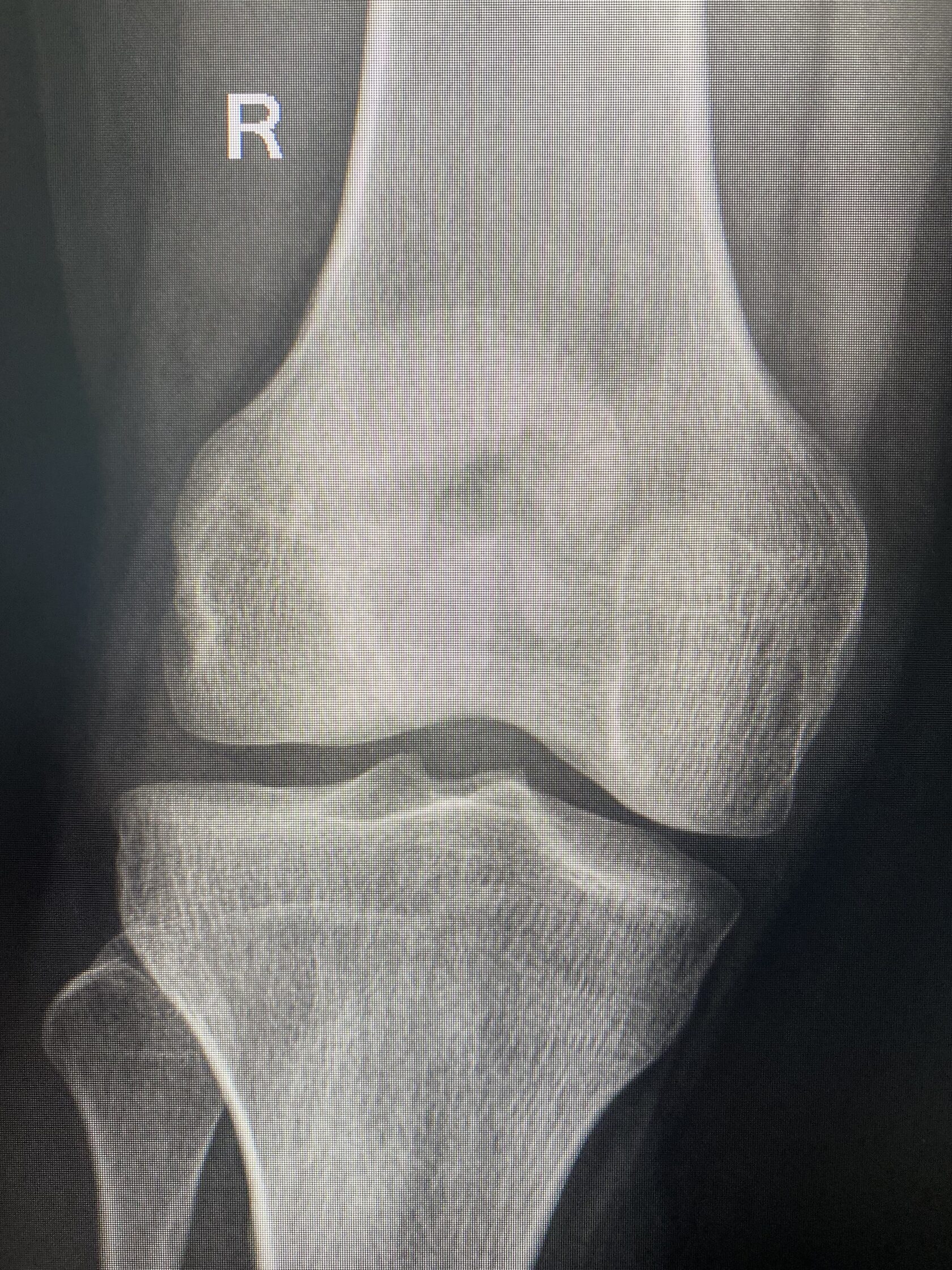 Артроз коленного сустава 1 стадии