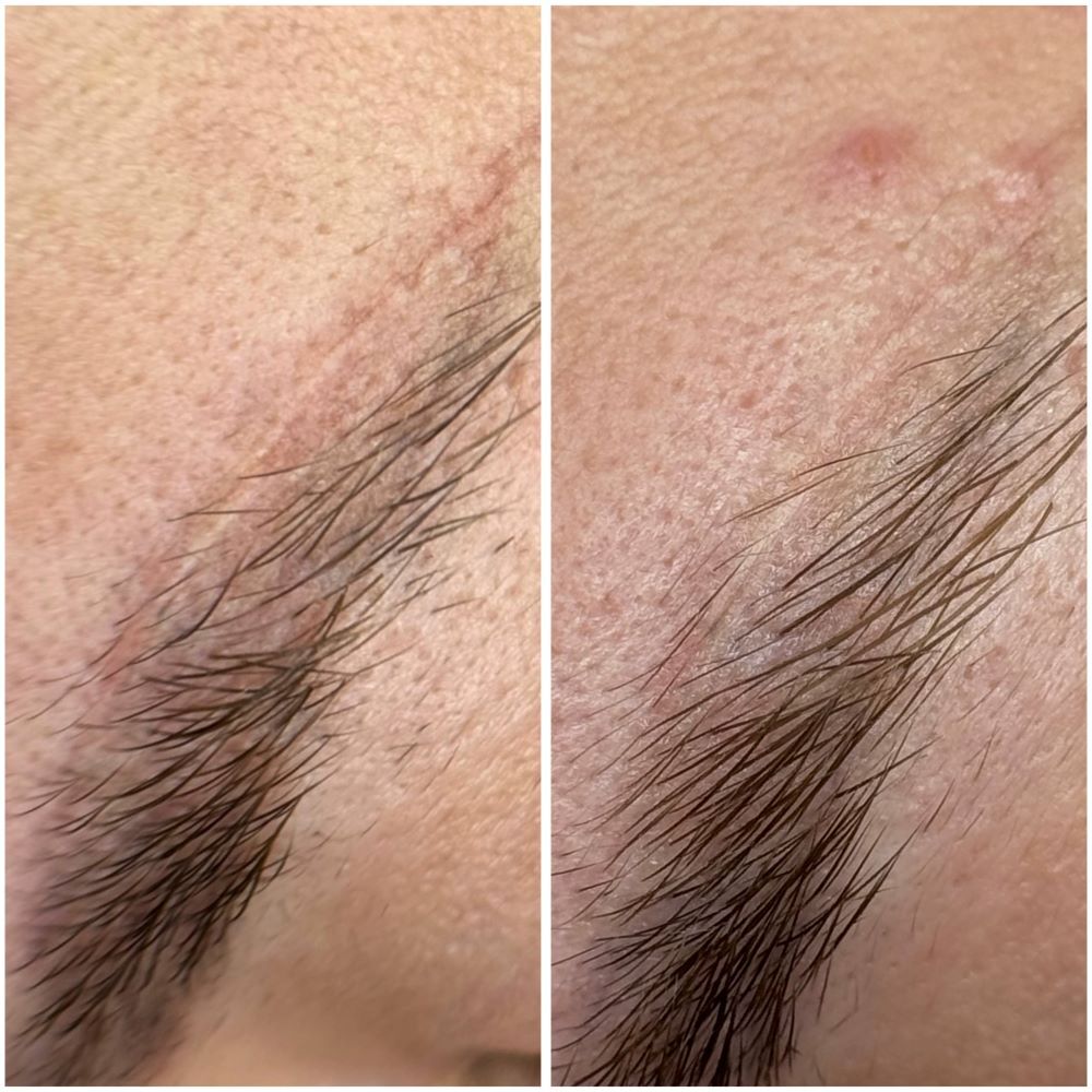 удаление микроблейдинга москва