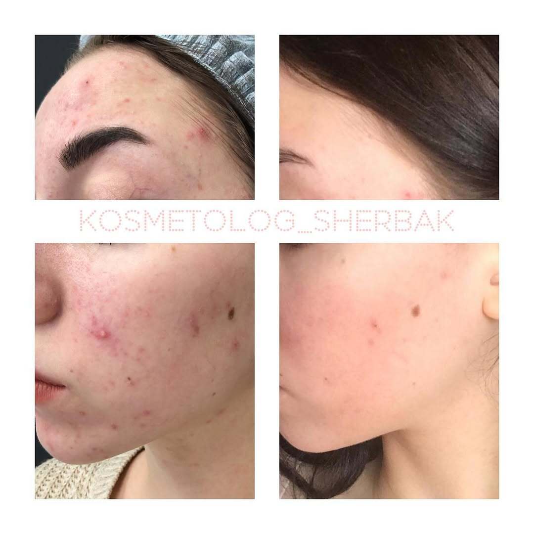 Лечение акне у женщины в клинике PradusCOSMO, СПб. До и после процедуры