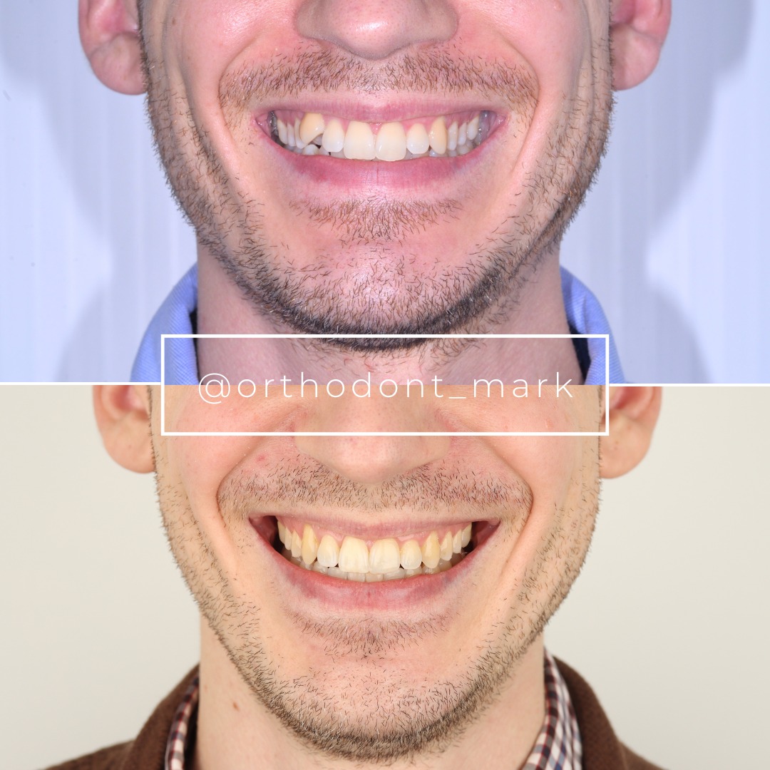 Before photo showing canine dystopia and mesialization from early primary tooth loss — photo 1 of 3