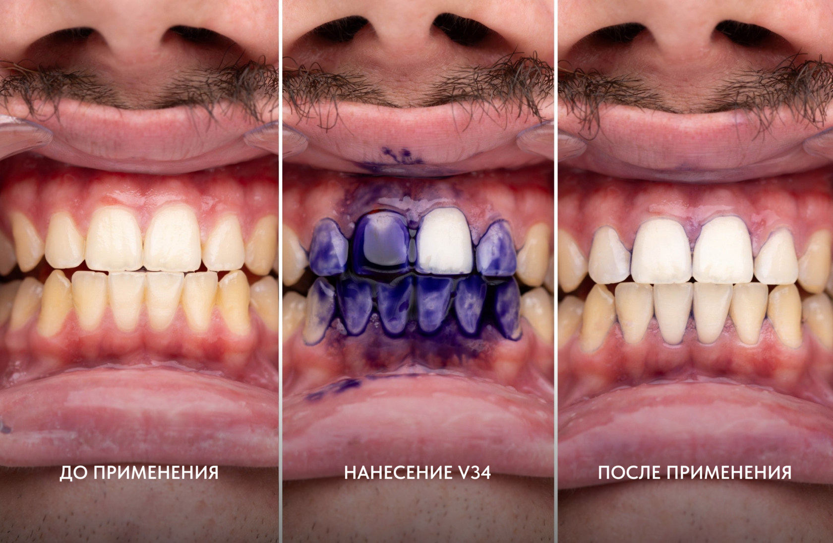 hismile v34 color corrector