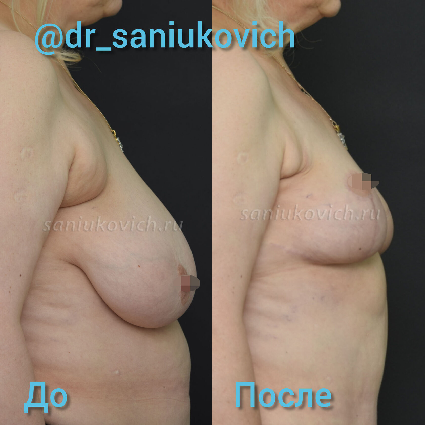 уменьшение груди у женщин фото 86