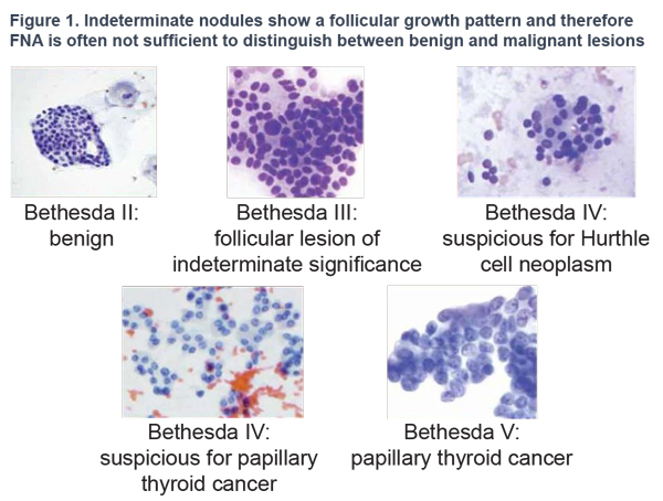 Introducing ThyroiNow: Digital Thyroid Cancer Panel