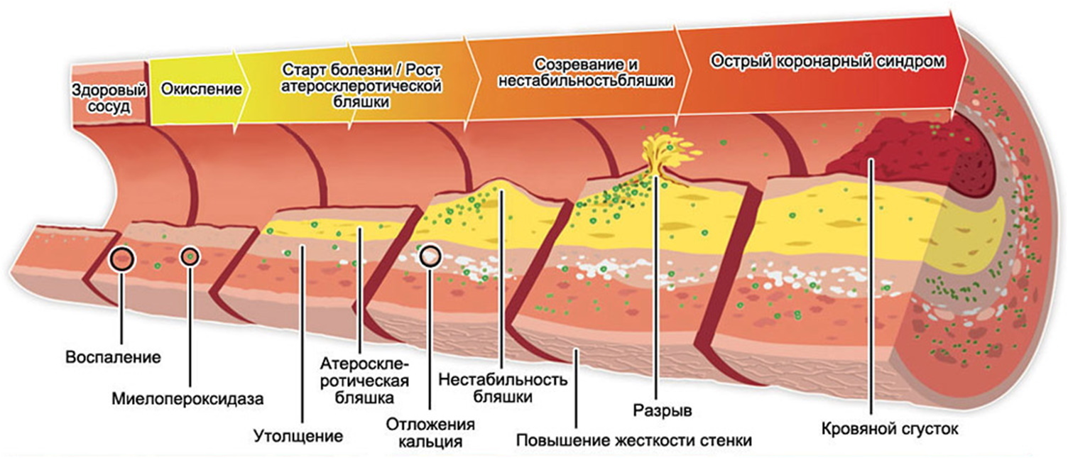 Облитерирующий атеросклероз картинки