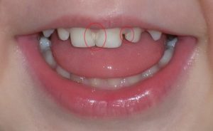 Возникновение дырок в зубах: причины