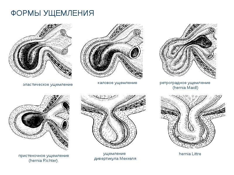 Защемление грыжи. Эластическое ущемление грыжи. Ущемление Меккелева дивертикула грыжа Литтре. Эластическое ущемление грыжи механизм. Грыжа дивертикула Меккеля.