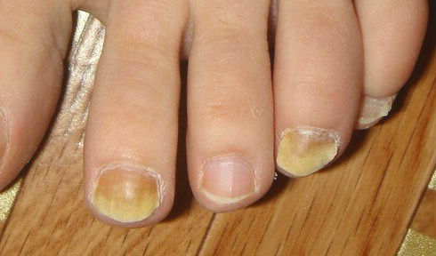 Что расскажут ногти о здоровье: изменение цвета ногтей