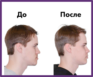 Установка имплантов в Дербенте. Имплантация при отсутствии одного зуба.