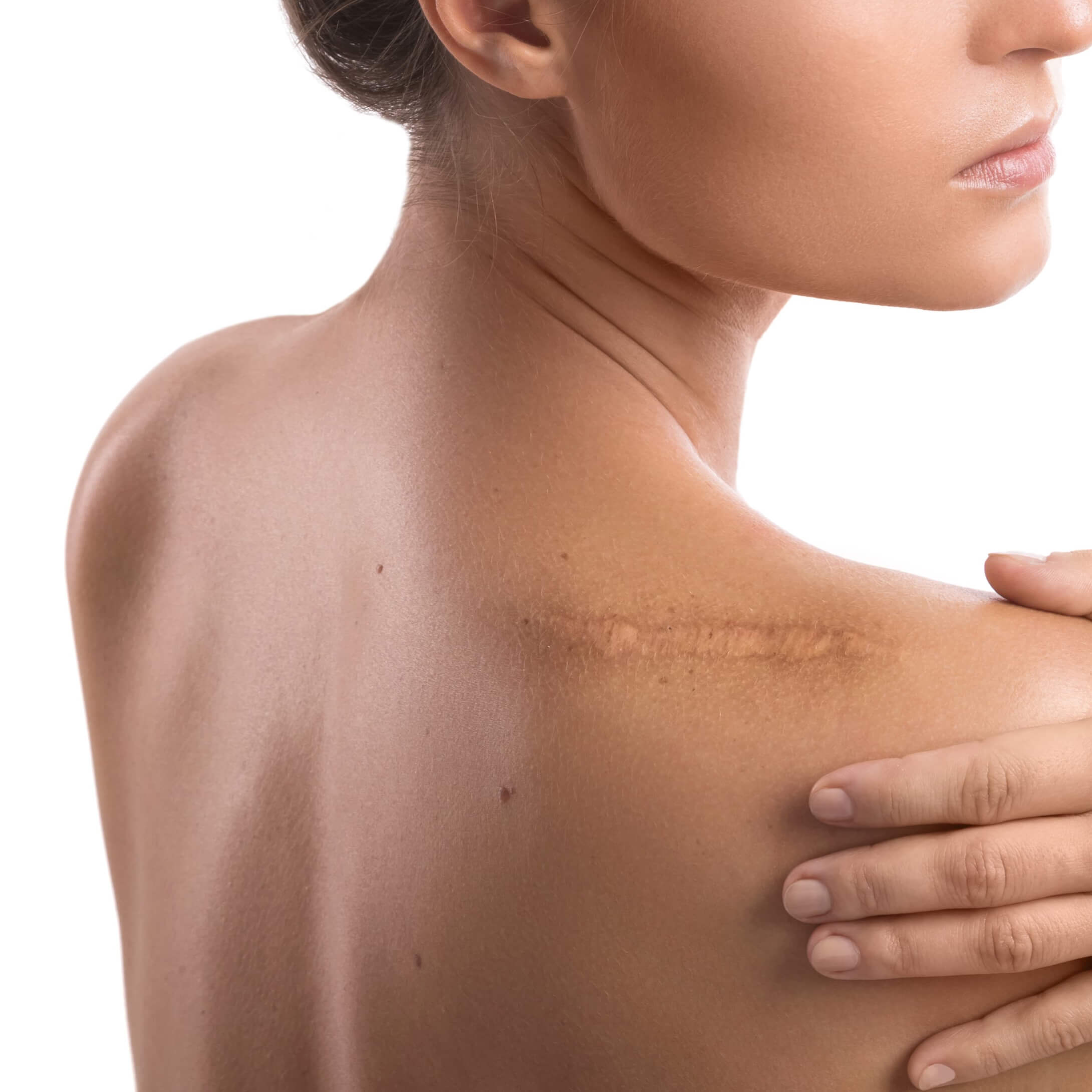 Лечение рубцов в Красноярске