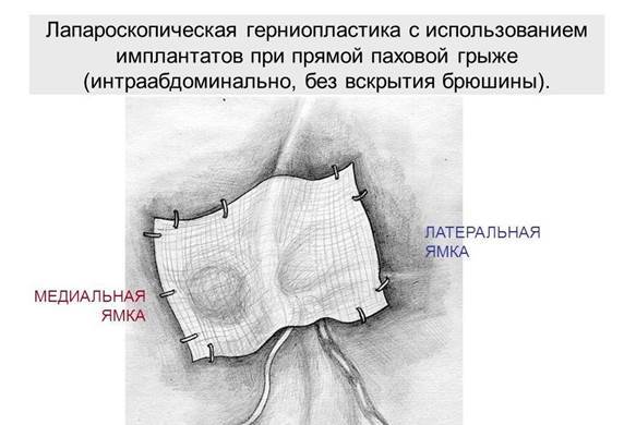 Йодная сетка при кашле взрослым как рисовать