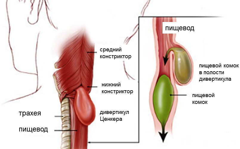 Дивертикул пищевода ценкера