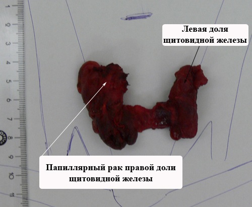 Рак щитовидной железы: лечение, операция по удалению опухоли в СПб, цена