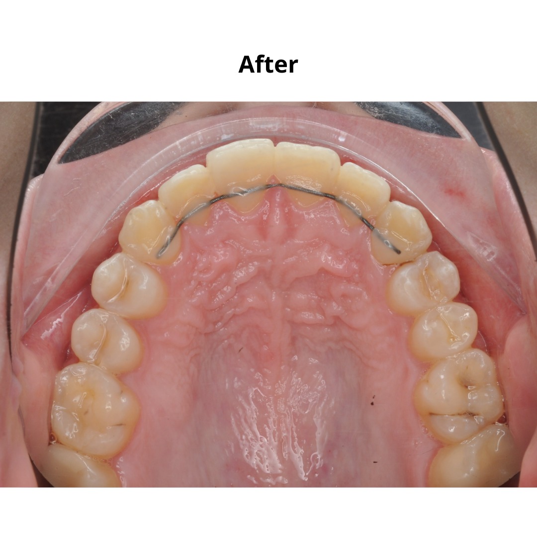 Stage showing continued alignment of the canine and adjacent teeth — photo 4 of 7