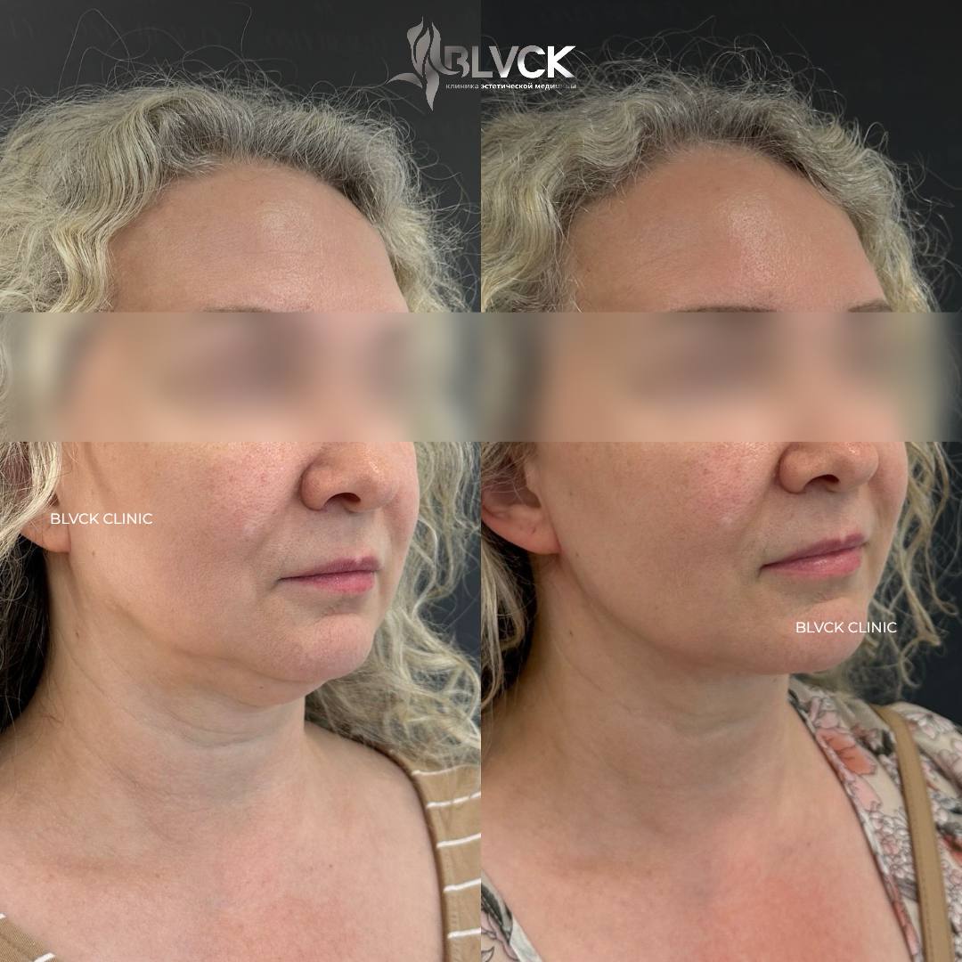 результат устранения второго подбородка в Blvck Clinic процедурой Smas-лифтинга