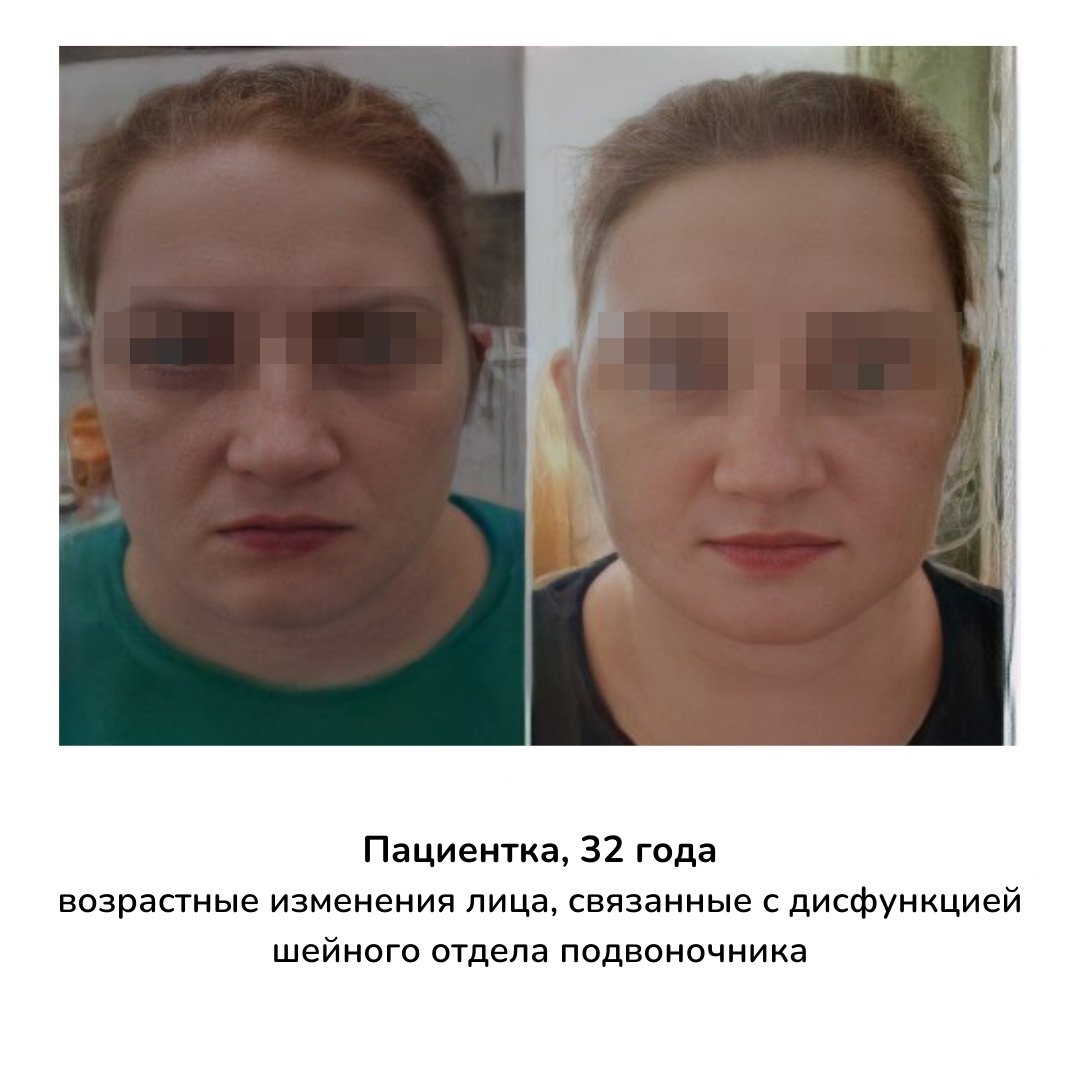 Как осанка влияет на лицо фото до и после
