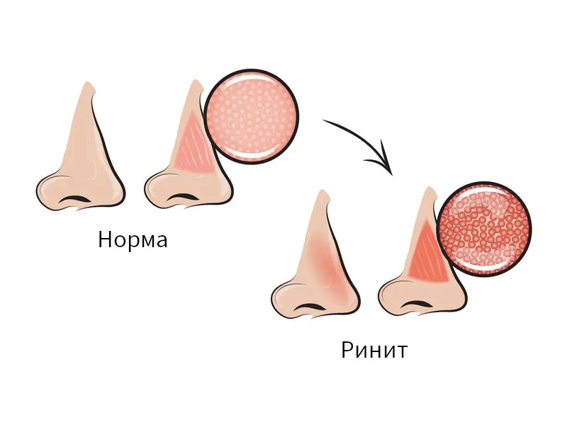 Аллергический ринит картинки для презентации