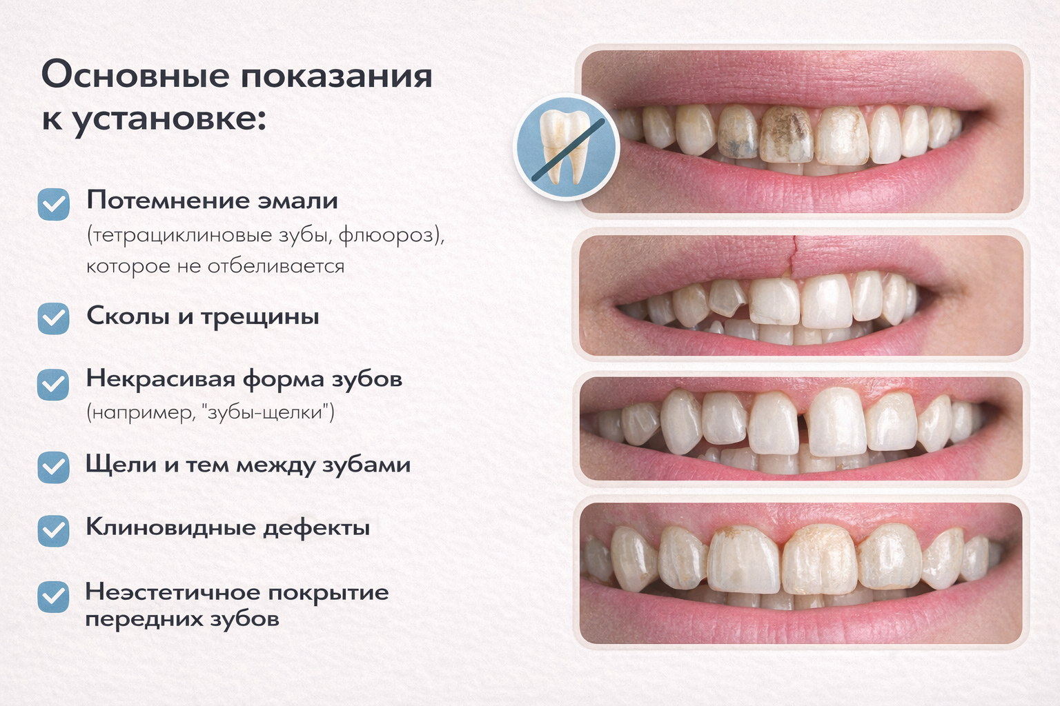 Когда нужно ставить виниры: основные показания в Москве