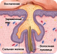 Образование угрей на коже