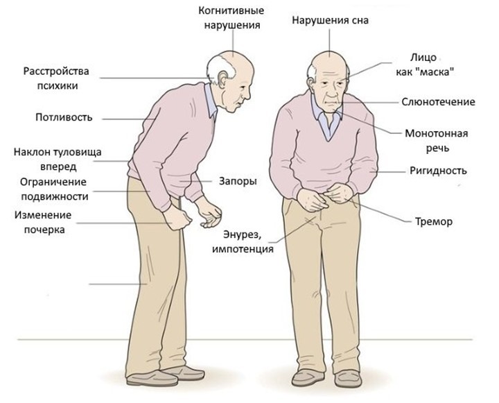 Методы диагностики нарушений ходьбы и постуральной устойчивости при болезни Паркинсона