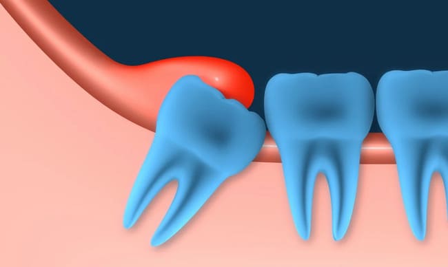 Воспаление зубного нерва - полезная информация от врачей стоматологии доктора Фролова