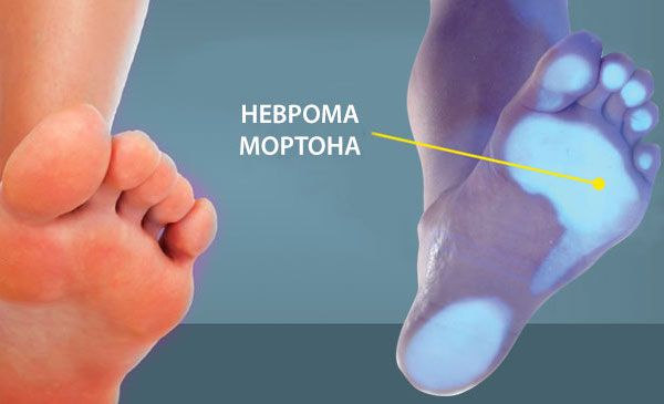 Невринома Мортона