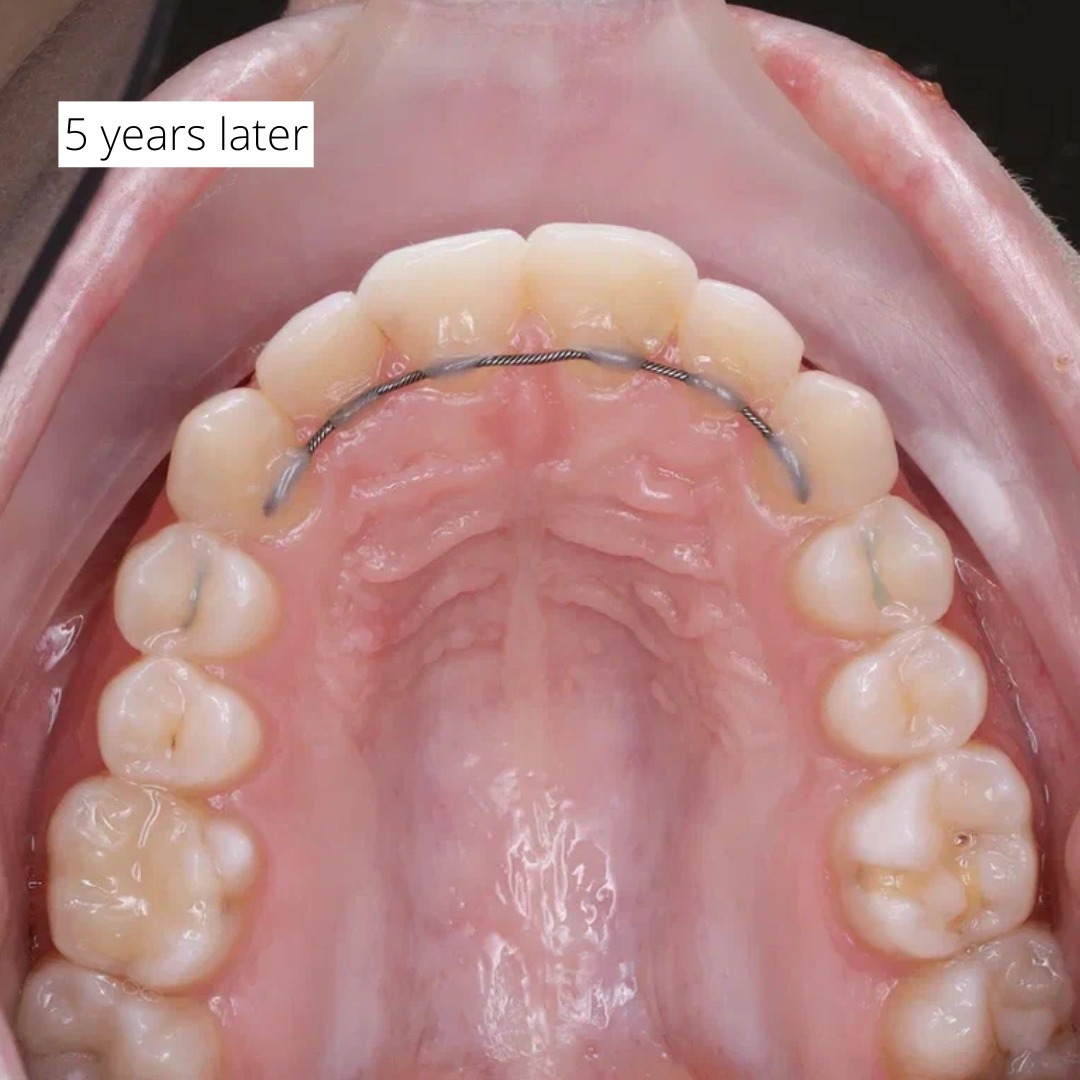 Progressive alignment view showing correction of the crossbite and canine position — photo 4 of 6