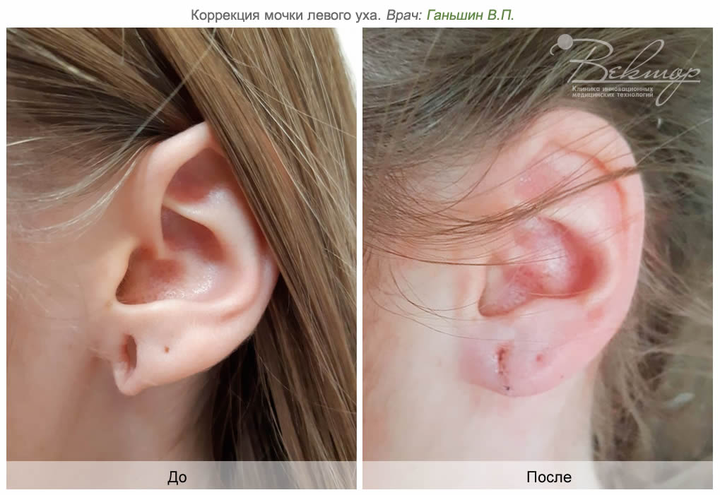 Выделения из уха (оторея) — причины, обследование и лечение | Симптомы | Клиника «Консилиум»
