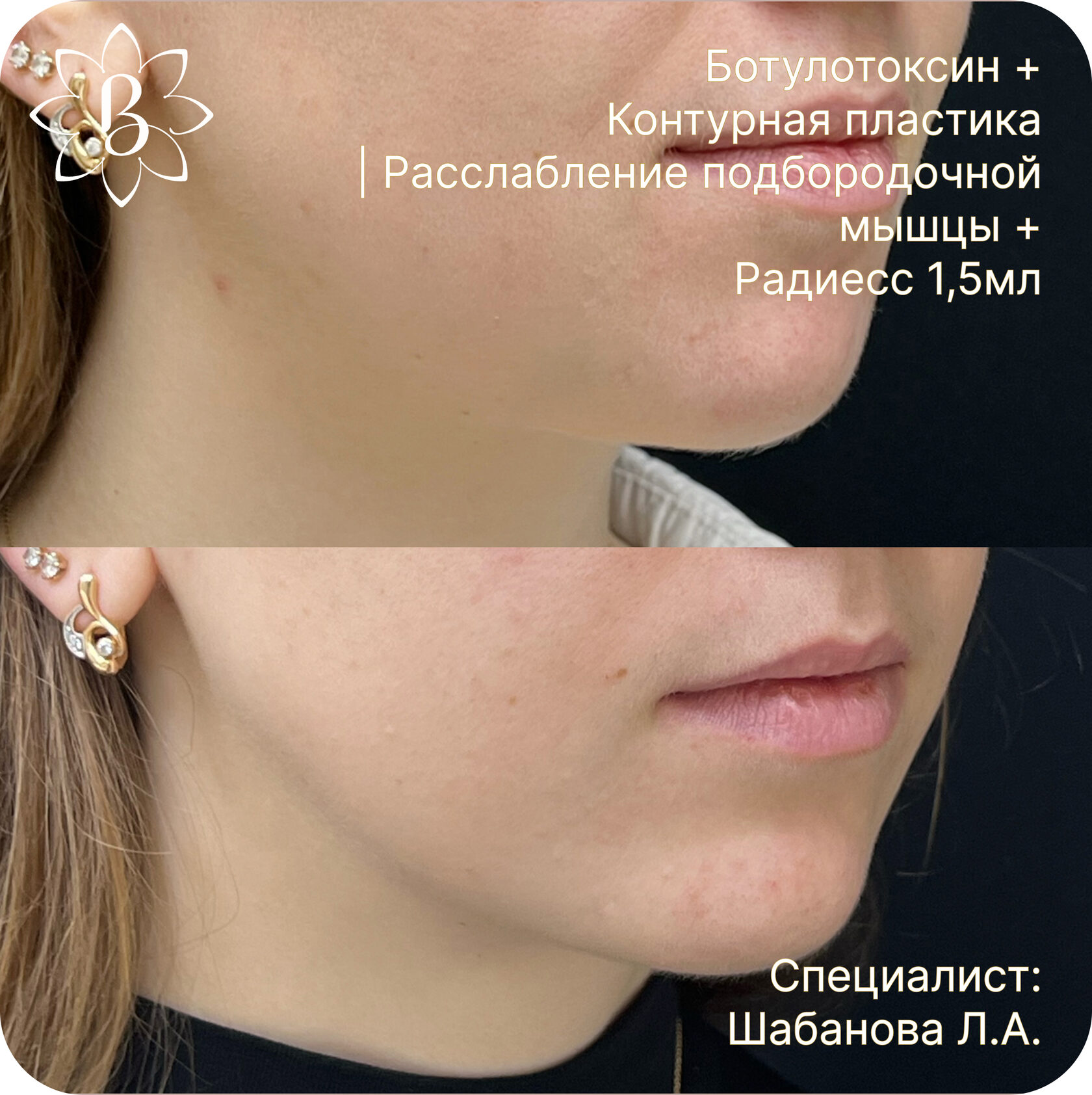 Александритовая лазерная эпиляция