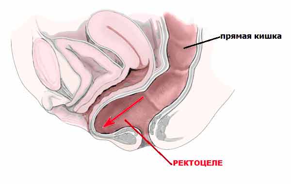 Что такое ректоцеле, симптомы ректоцеле, как лечить ректоцеле