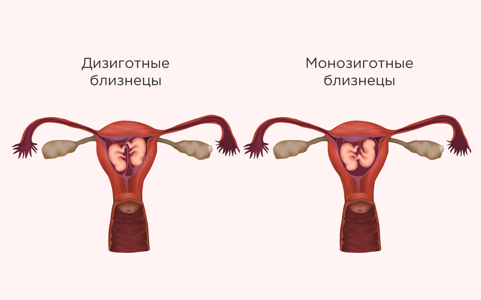 Редукция эмбрионов при многоплодной беременности