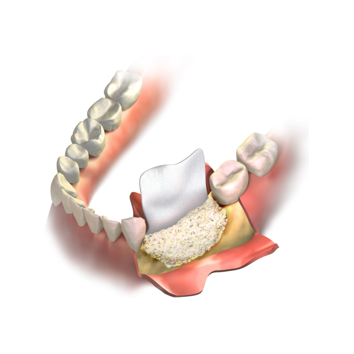 Наращивание кости в стоматологии