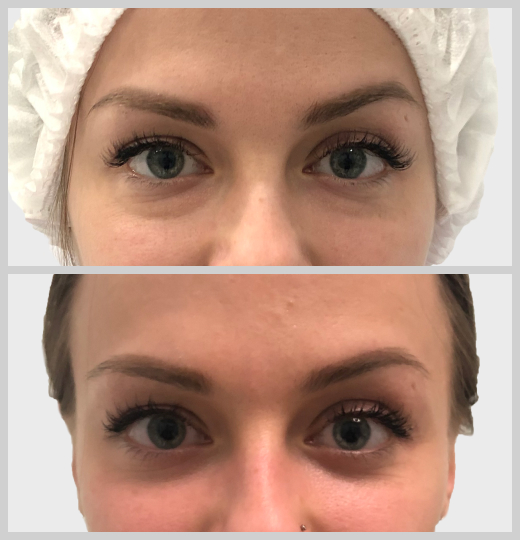 блефаропластика нависшие веки