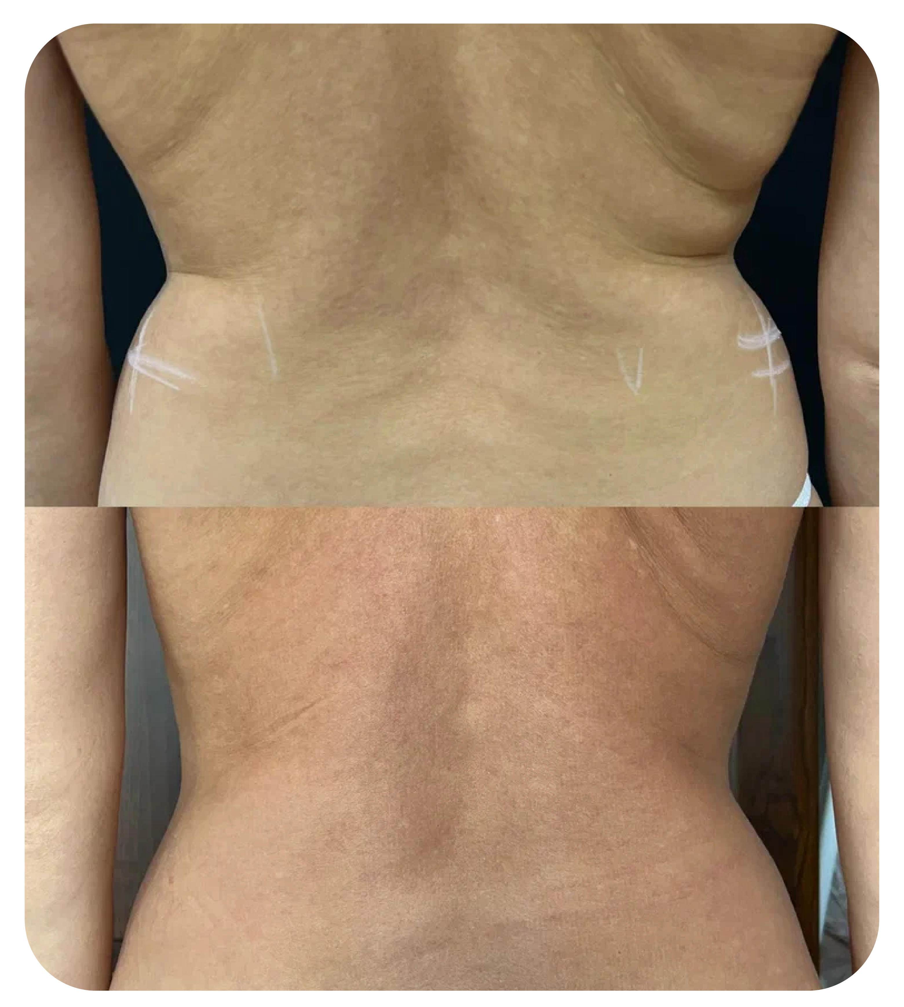 Липосакция СПб