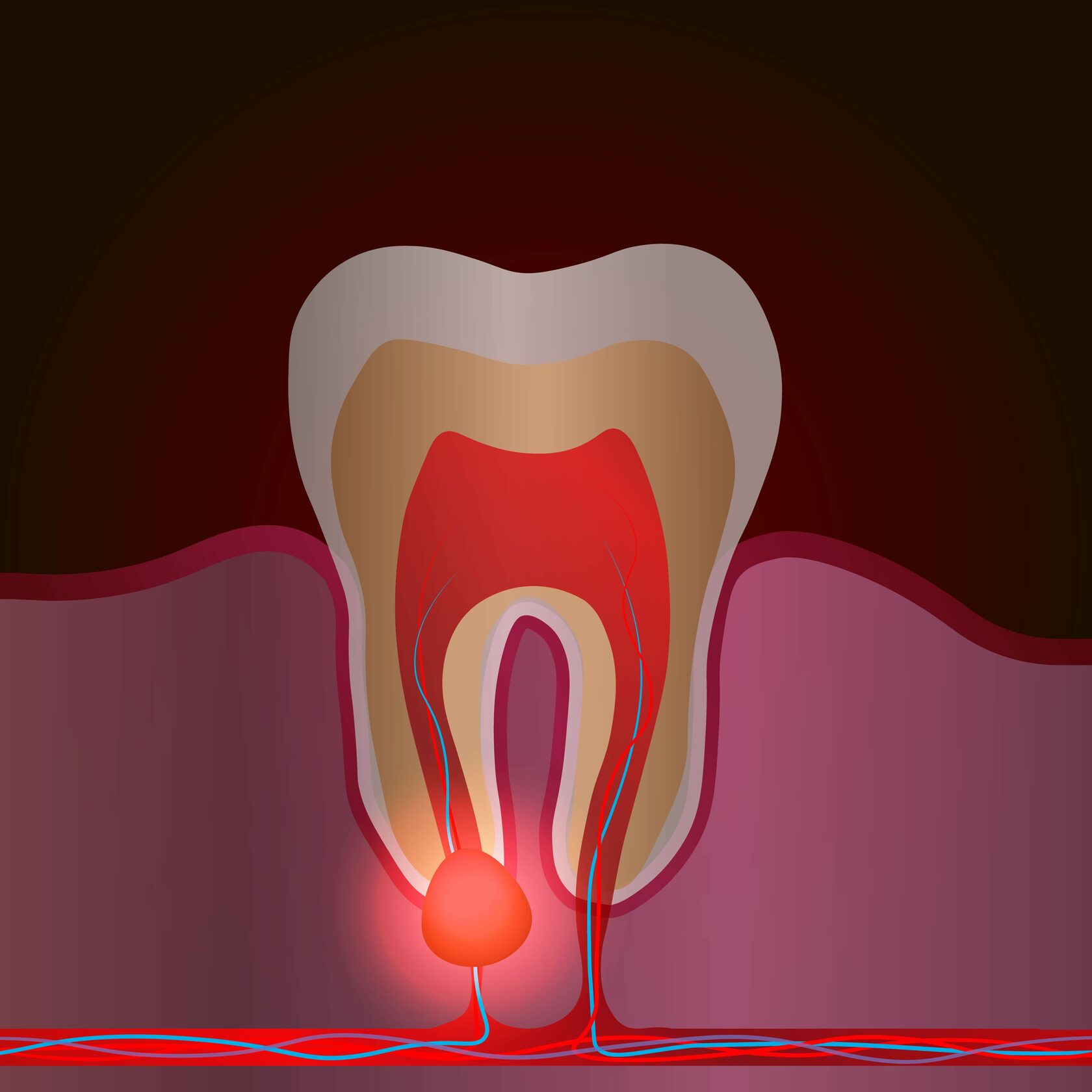 киста лечение зубов краснодар