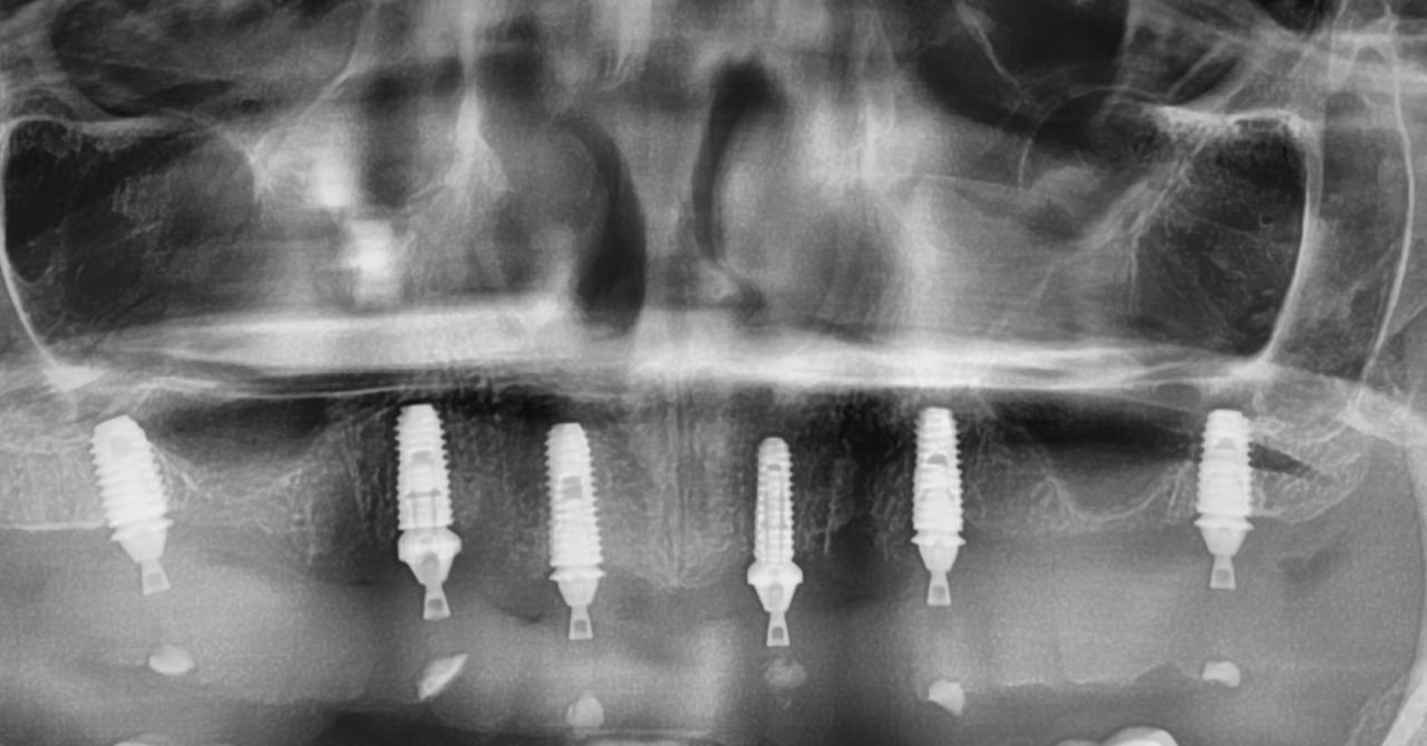 Замена разрушенных зубов и старых протезов на импланты и временные конструкции