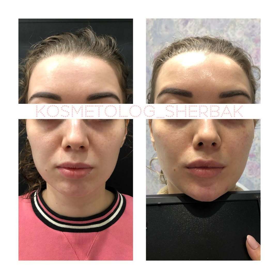 Контурная пластика лица в клинике PradusCOSMO, Санкт-Петербург. Естественный результат без эффекта переделанного лица