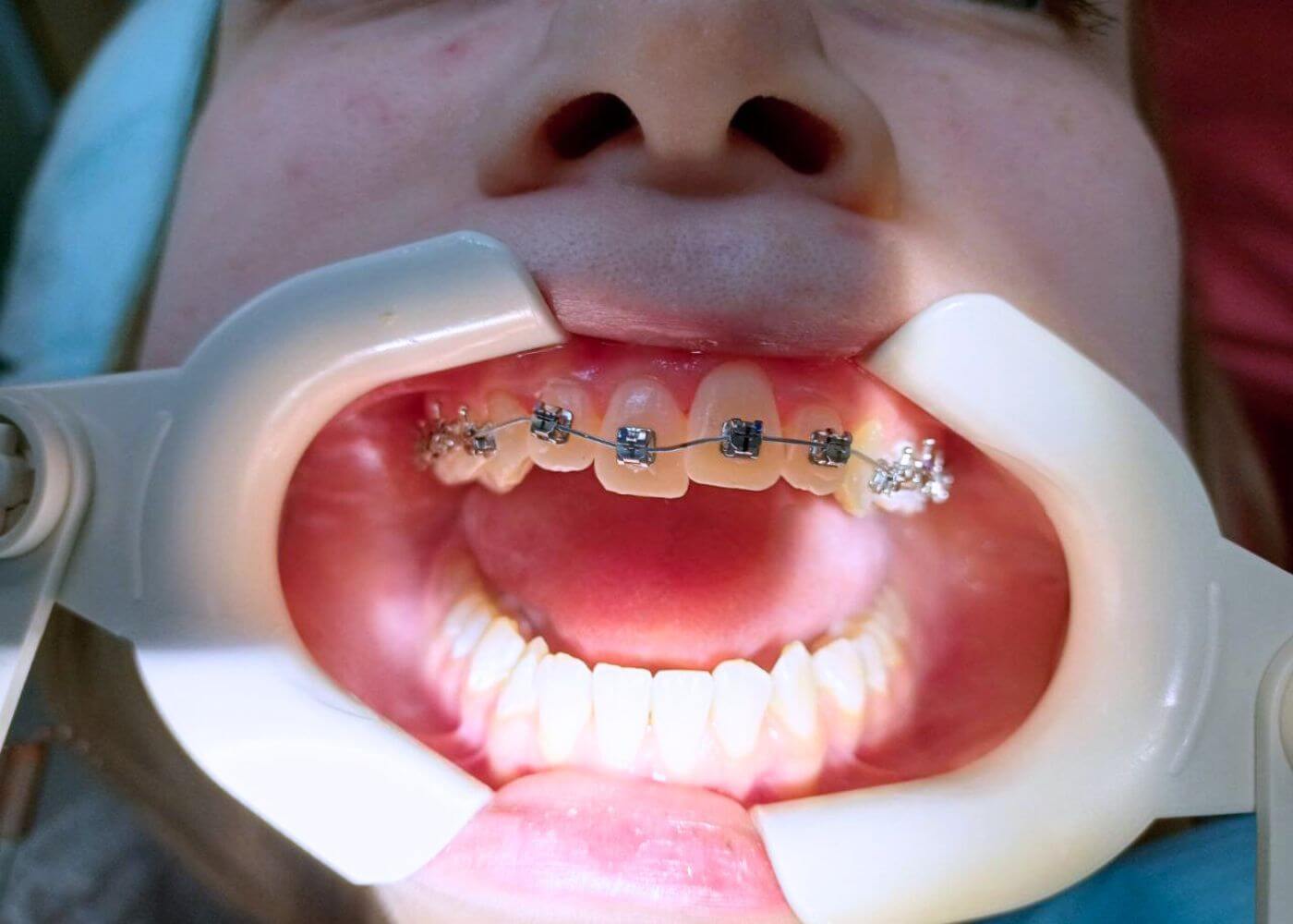 Почему не смыкаются зубы после установки брекетов? | Статьи