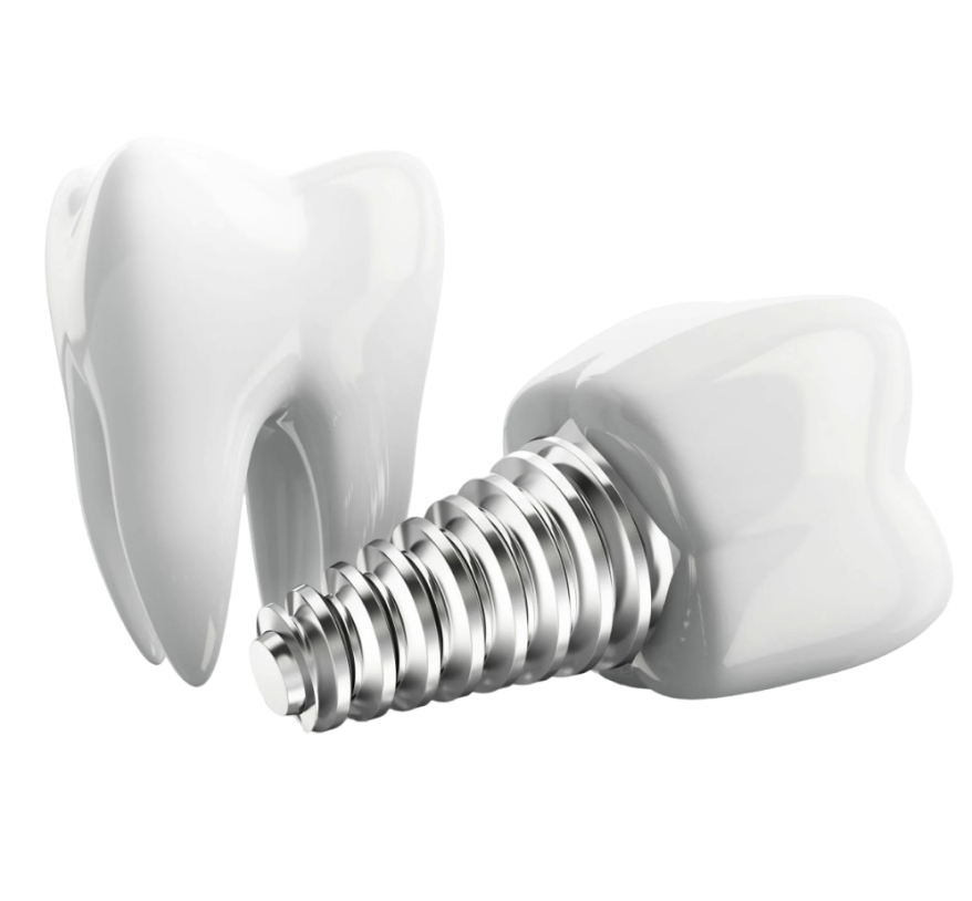 Имплантат. Имплантация челюсти на 4 имплантах (ab Dental, Noris Medical, Израиль). Зубные импланты Дентал.