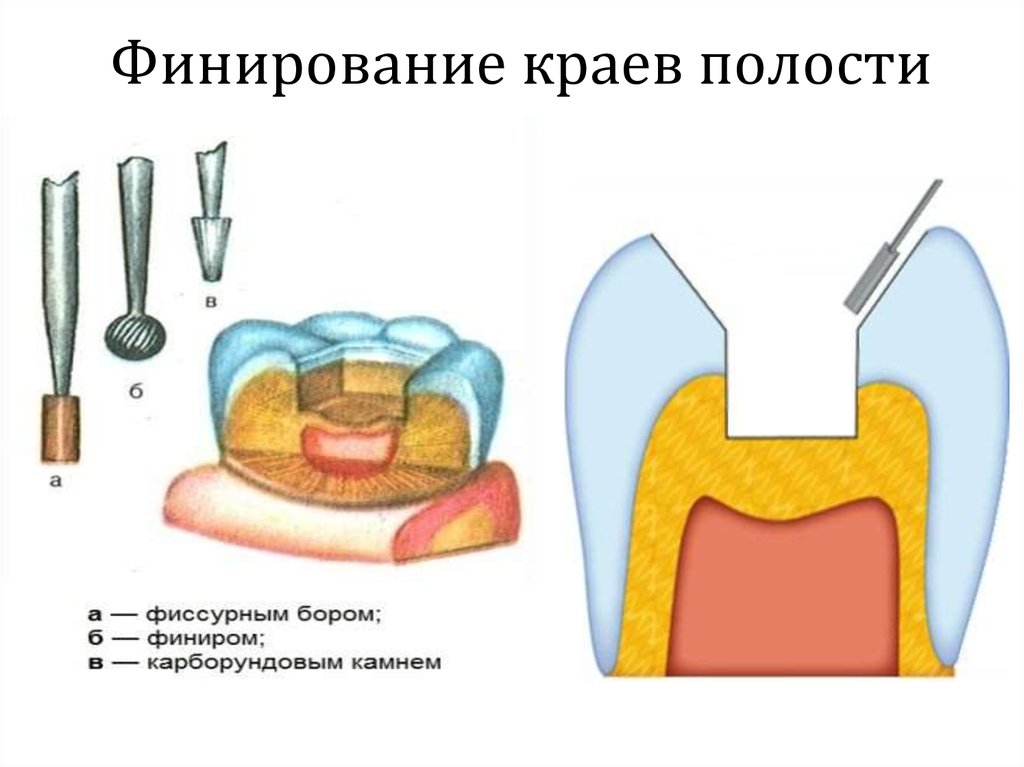 Полость готовиться. Финирование краев кариозной полости. Финирование краев эмали 5 класс по Блэку. Финирование краев эмали 1 класса по Блэку. Этапы препарирования кариозных полостей 1 класса по Блэку.