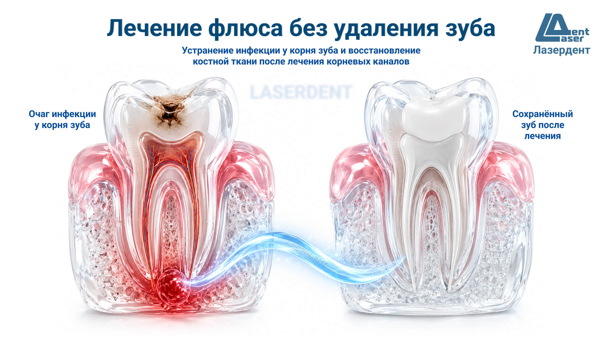 Можно ли вылечить зуб с флюсом без удаления: воспаление у корня зуба, лечение корневых каналов и сохранение собственного зуба