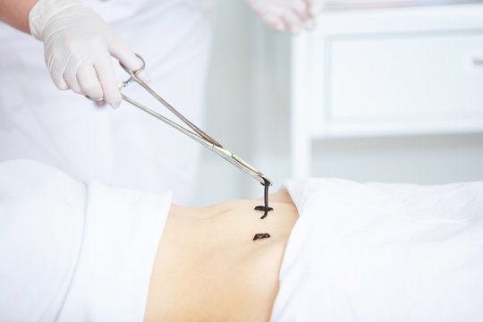 Гирудотерапия — лечение пиявками