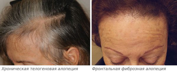 Хроническая телогеновая и фронтальная фиброзная алопеция