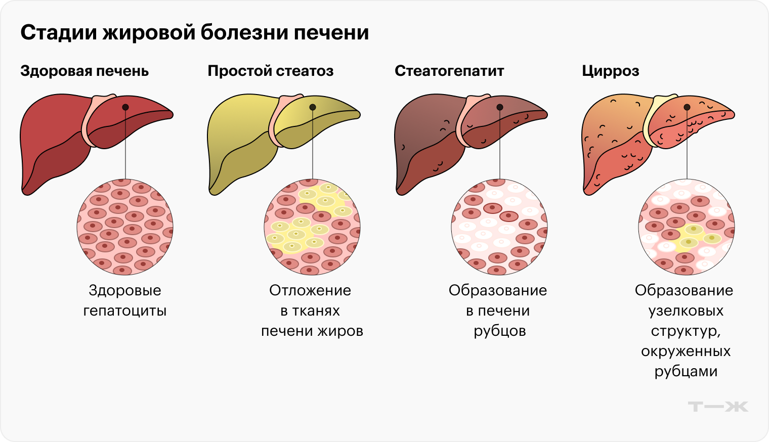 Стадии жировой болезни печени: здоровая печень, стеатоз, стеатогепатит, цирроз