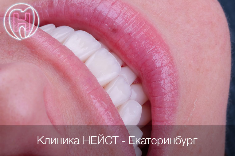 керамические виниры цвет Блич 2 (Bleach2)