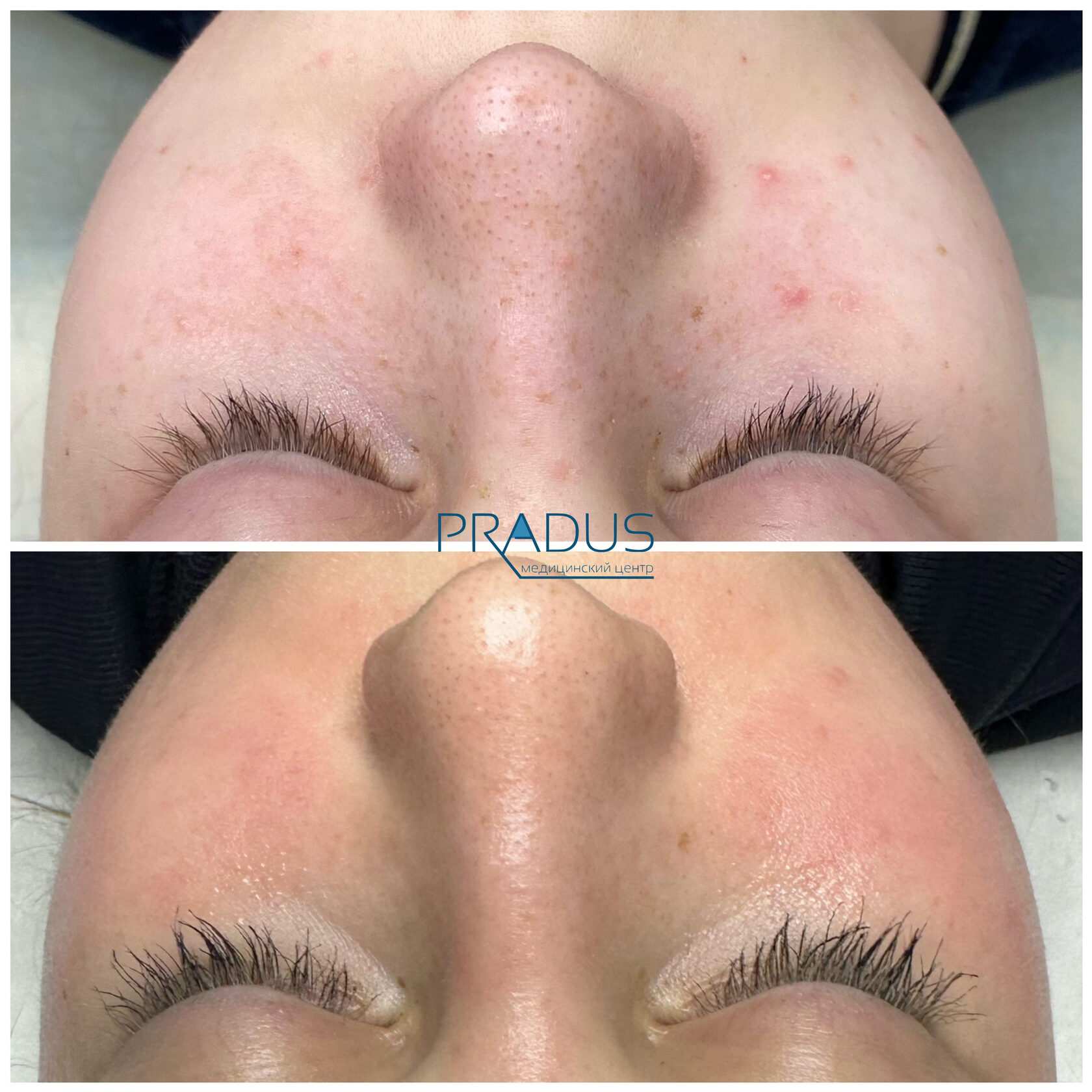 Лечение акне у женщины в клинике PradusCOSMO, СПб. До и после процедуры