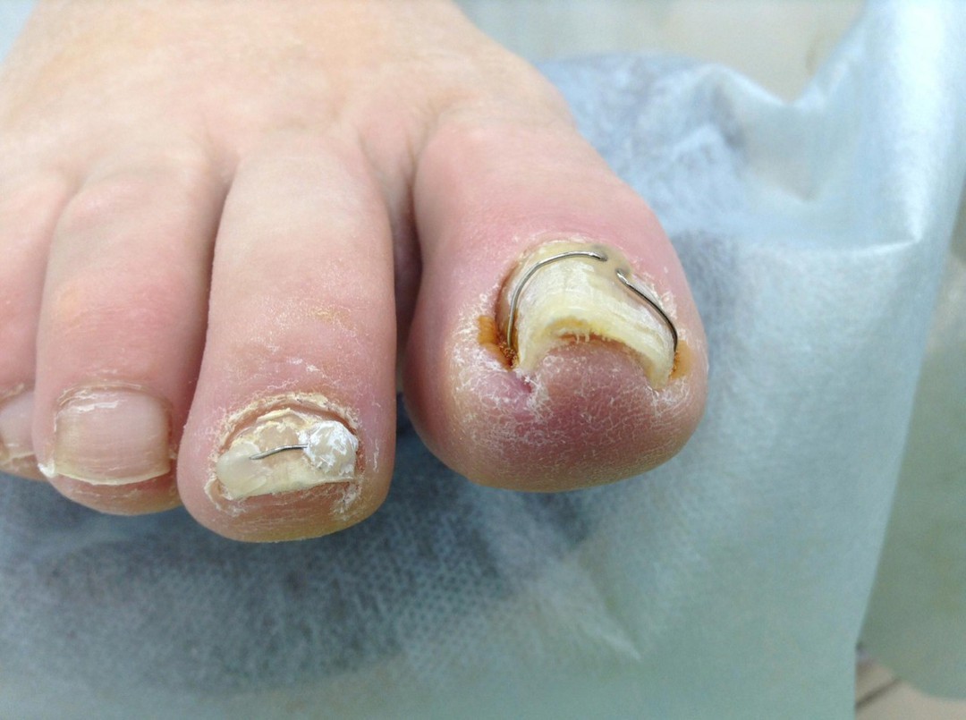 Коррекция вросшего ногтя в Курске