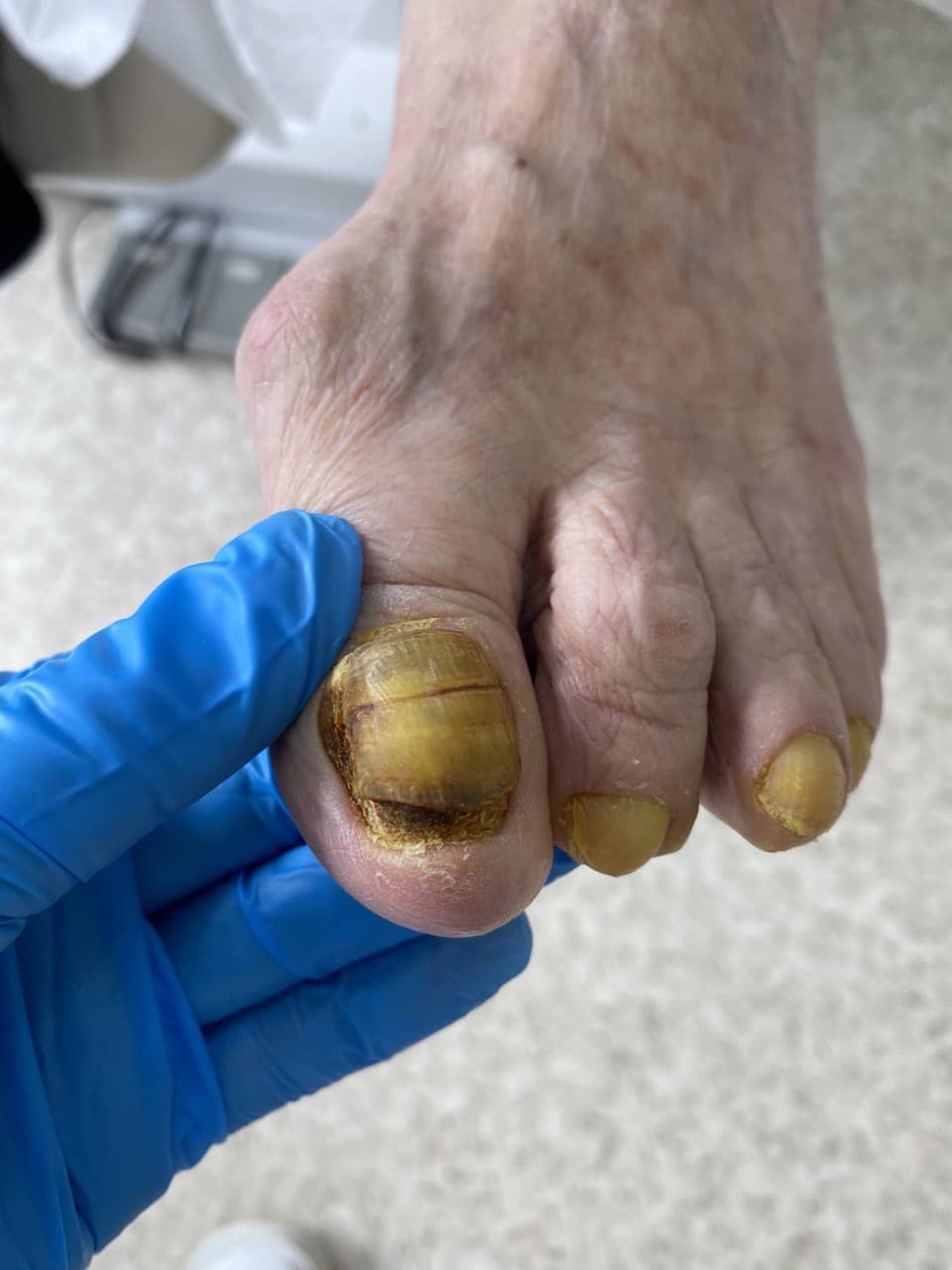 онихолизис причины